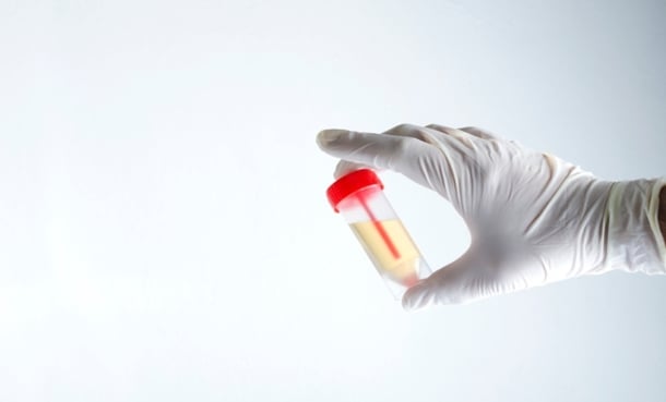 Urine Tumour DNA Predicts BCG Recurrence - EMJ