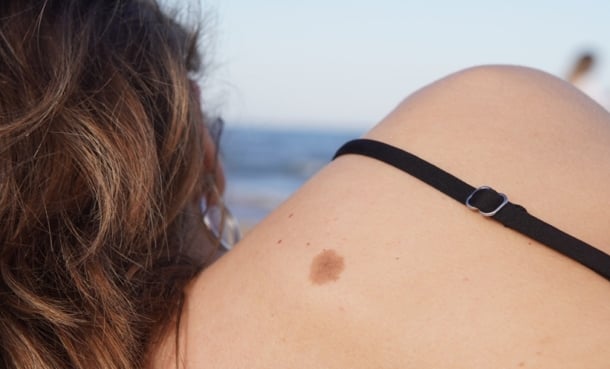 Cutaneous Squamous Cell Carcinoma Trends - EMJ