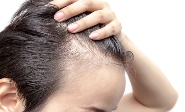 Man with receding hair line and hair loss