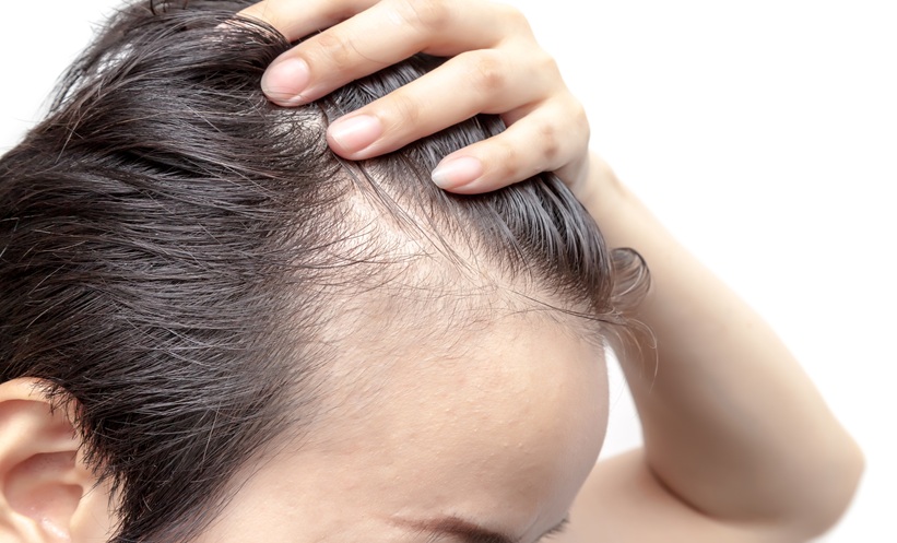 Man with receding hair line and hair loss
