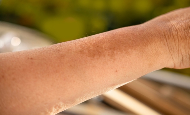 Tofacitinib for Dermal Hyperpigmentation - EMJ