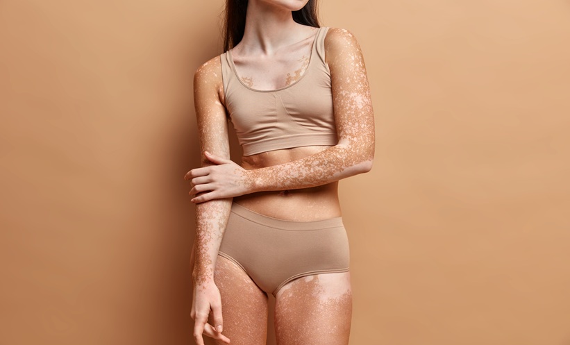 person with vitiligo