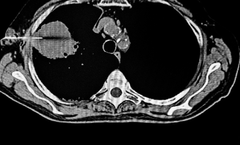 CEUS-Guided PTNB For Lung Lesions - EMJ