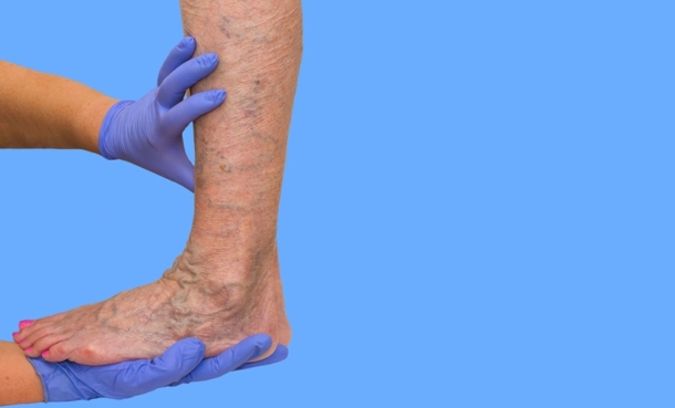 showing vascular blood clot and endothelial inflammation in venous thromboembolism in rheumatoid arthritis