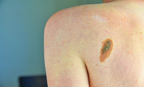 Close up picture of dangerous brown nevus on human skin - melanoma