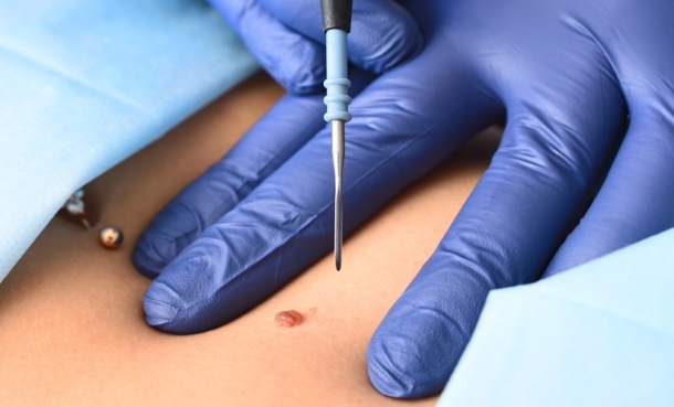 a dermatologist injects melanoma with vaccine