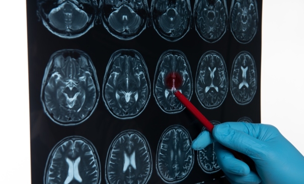 brain tumor