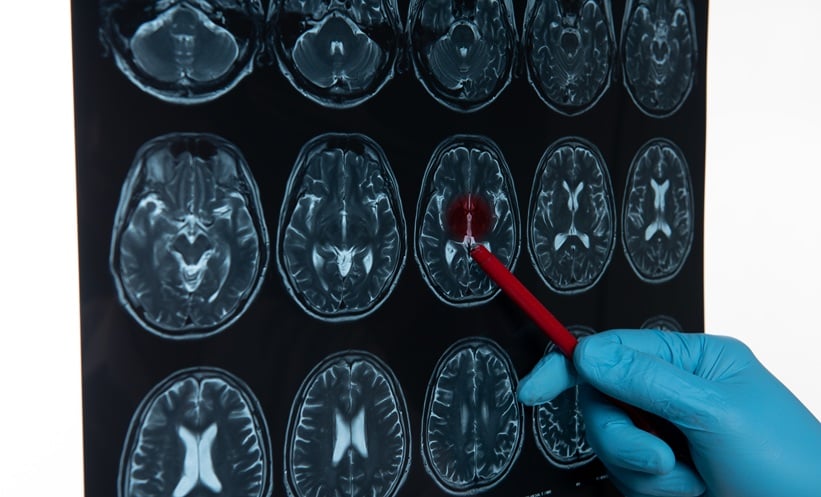 brain tumor
