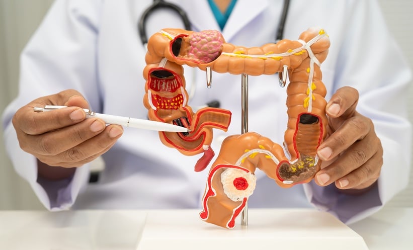 Person pointing to a model of the colorectal system