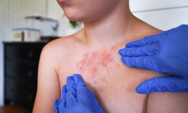 Child with red rash on chest being examined by doctor who wears blue latex gloves