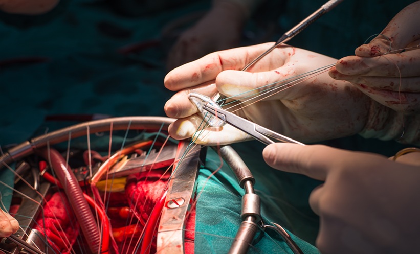 Mitral regurgitation