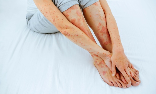 generalized pustular psoriasis