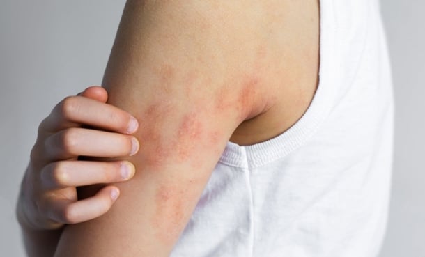 Dupilumab Paediatric Atopic Dermatitis