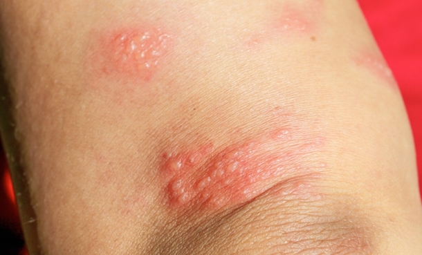 efgartigimod pemphigus treatment