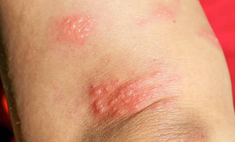 efgartigimod pemphigus treatment