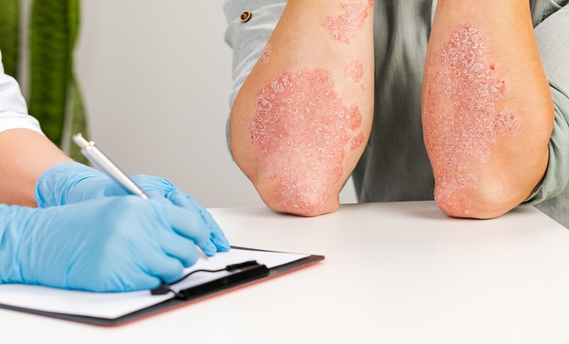 Generalised Pustular Psoriasis Mortality Risk - EMJ