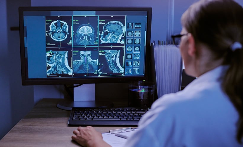 AI Brain Aneurysm Detection