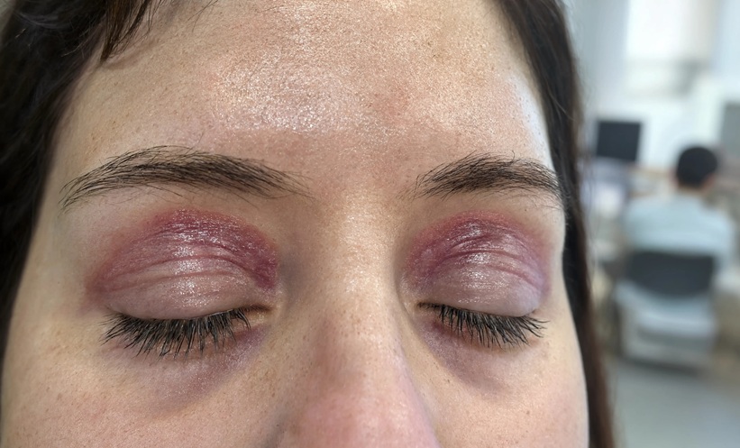 Clinical photo of heliotrope rash on patient eyelids, characteristic dusky purplish-red discoloration associated with dermatomyositis without Brepocitinib
