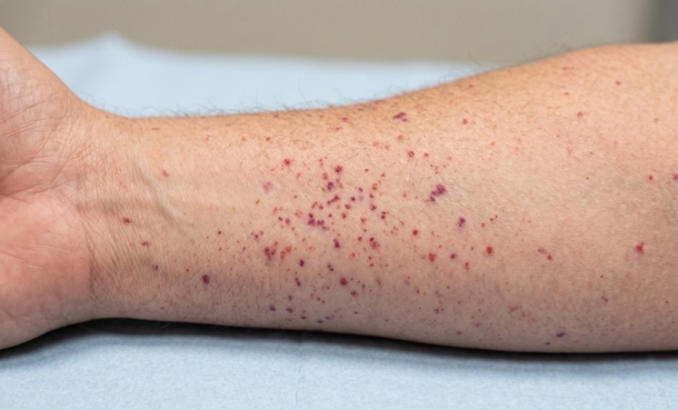 Cryoglobulinemic Vasculitis on skin from Hepatitis C