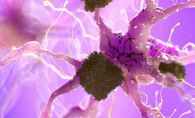alzheimer tau plaque neuron