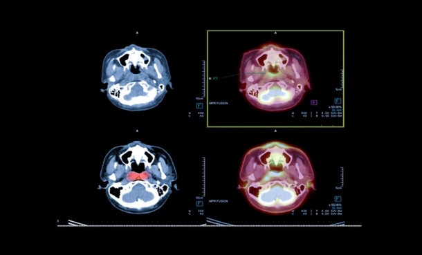 PET SCAN FOR BRAIN CANCER