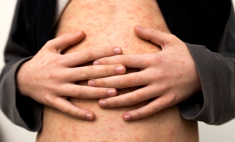 PERSON WITH MEASLES