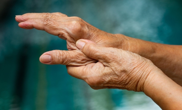 hand of patient with rheumatoid arthiritis