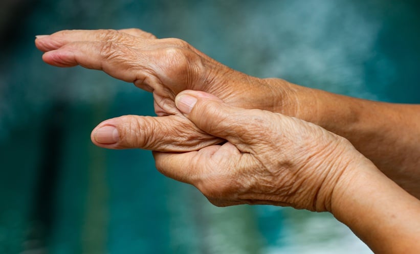 hand of patient with rheumatoid arthiritis