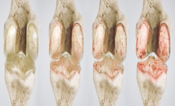 osteoarthritis of the knee in four stages