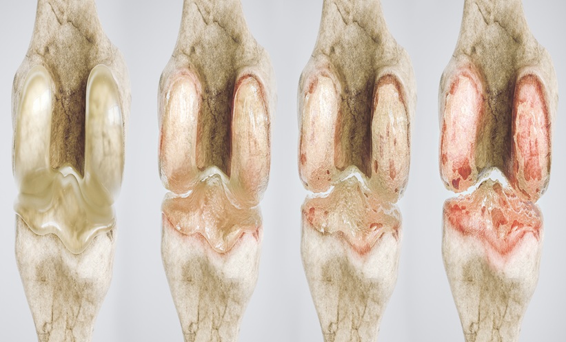 osteoarthritis of the knee in four stages