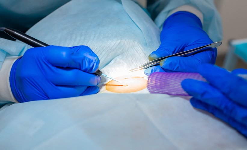 Clinician performing a skin biopsy to support the diagnosis of adult-onset Still’s disease.