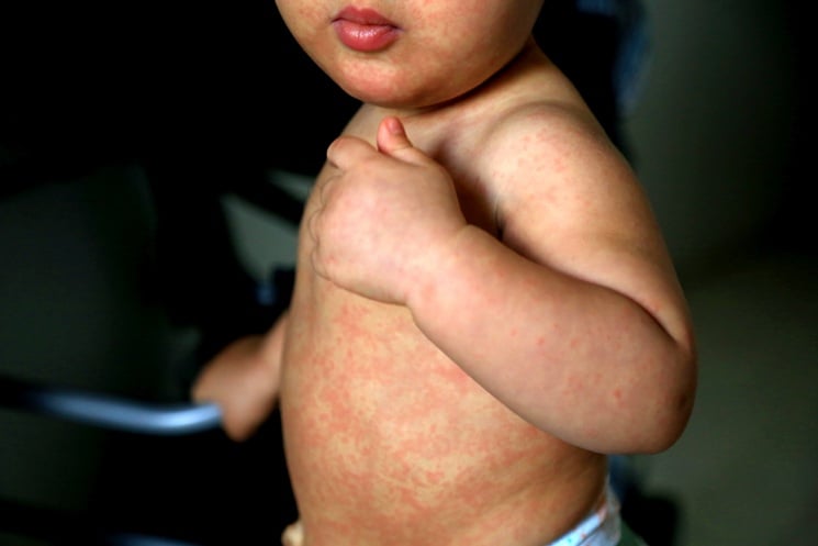 child with measles