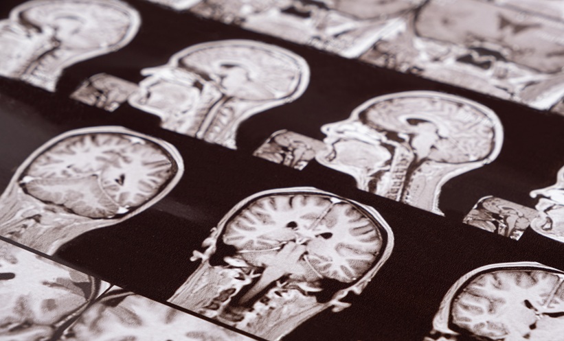 Brain MRI scans displayed on a diagnostic imaging sheet.