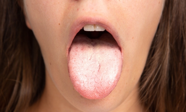 Person with tongue sticking out with dermatitis