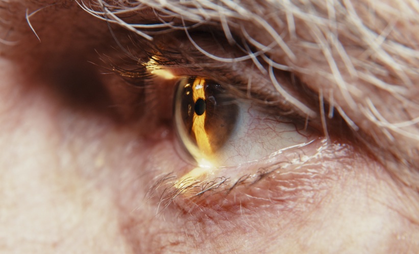 Closeup of a person's eye with glaucoma