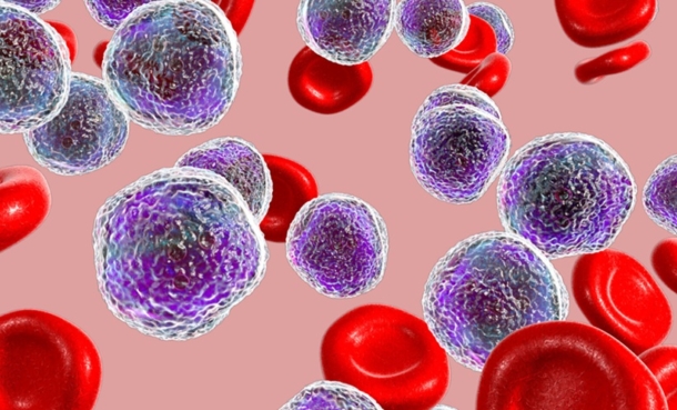 Leukemia