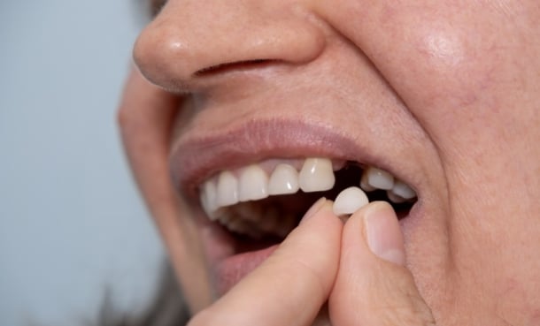 Tooth loss