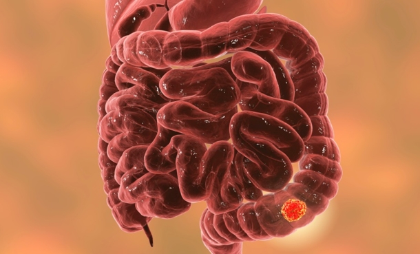 colorectal cancer