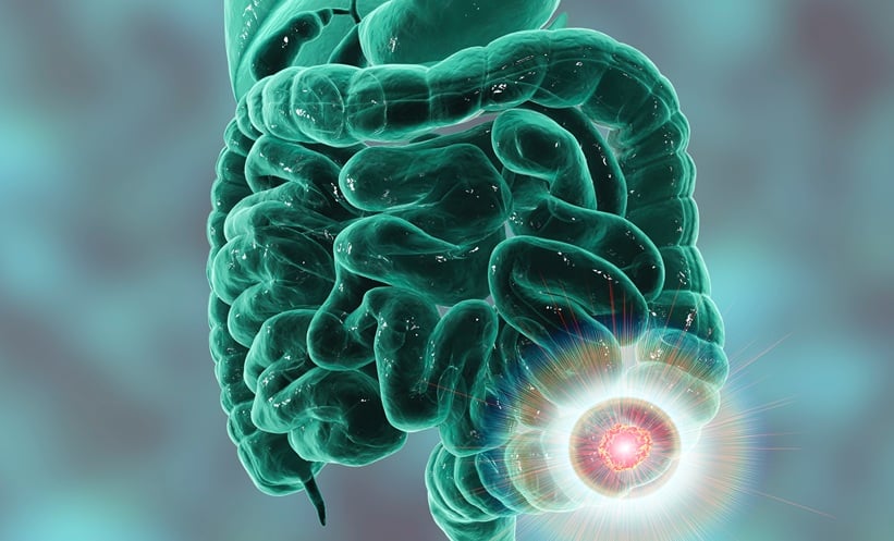 colon colorectal cancer