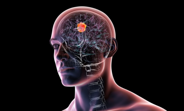 Brain cancer gliomarepresentation