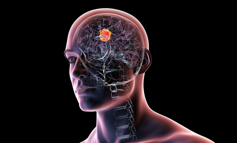 Brain cancer gliomarepresentation