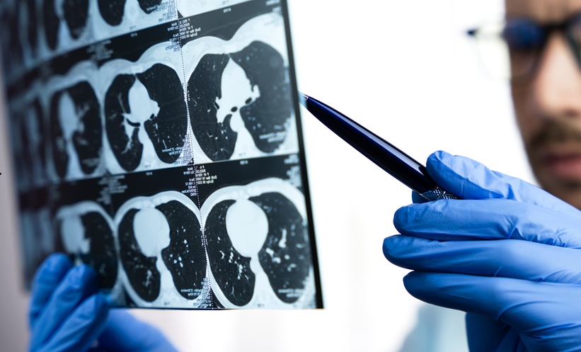 Person analyzing lung CT scans