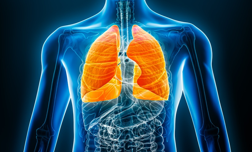 Computer image of pair of lungs, sever asthma
