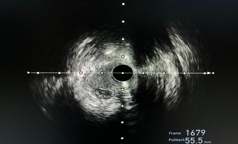 Clopidogrel Monotherapy After PCI Lowers Risk – EMJ