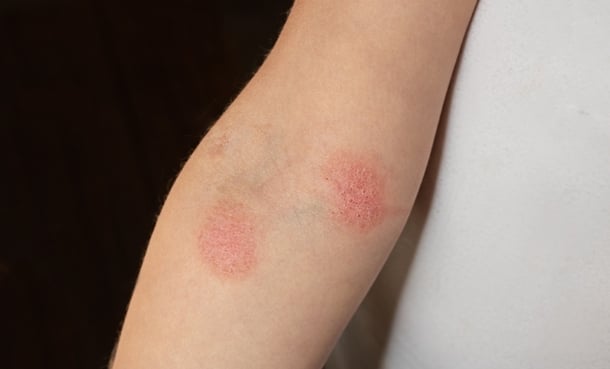 CLIPI Risk Stratification in Cutaneous Lymphoma – EMJ