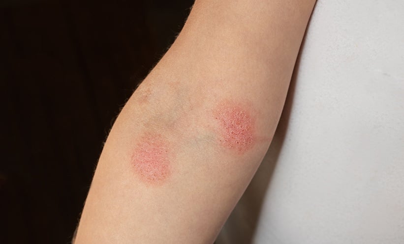 CLIPI Risk Stratification in Cutaneous Lymphoma – EMJ