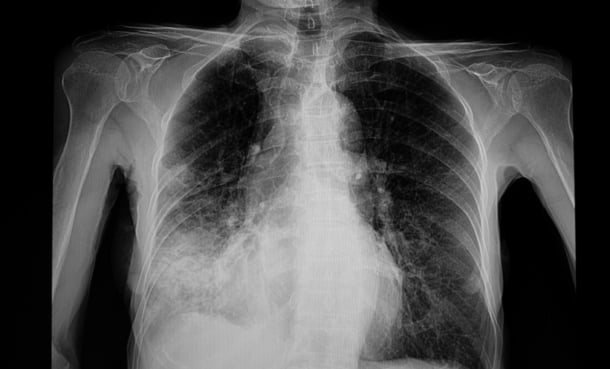 x ray of pneumonic plague in lungs