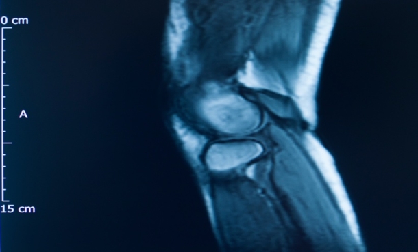 AI assisted joint MRI