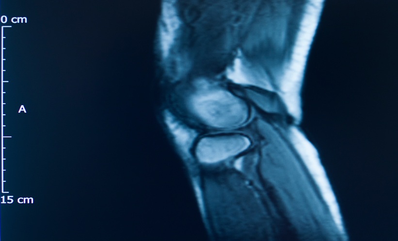 AI assisted joint MRI