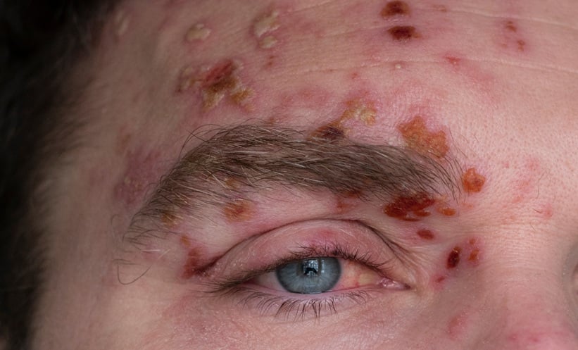 patient with varicella zoster meningitis appearance with scabs and redness
